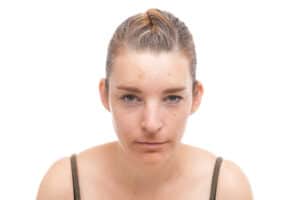 Fronsrimpels na de behandeling met Botox