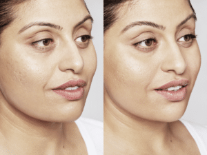 Acne littekens behandelen