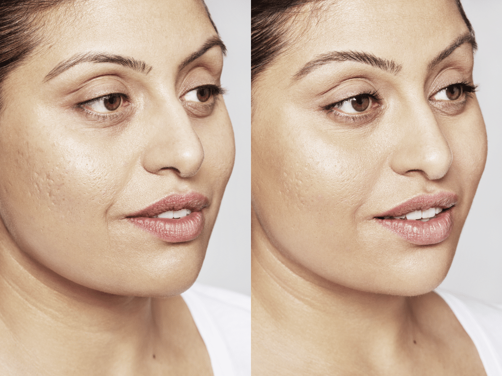 Acne littekens behandelen