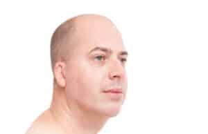 Kincorrectie met filler na de behandeling