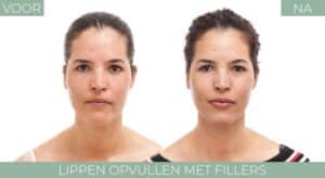 Voor en Na foto lippen opvullen